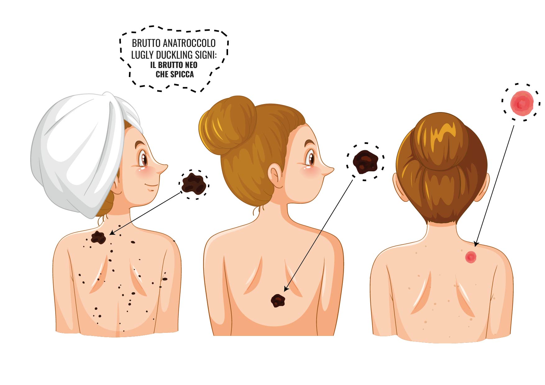 Illustrazione Brutto Anatroccolo — il neo che spicca