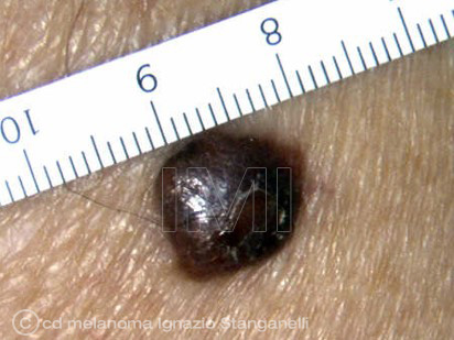 Melanoma cupoliforme nodulare