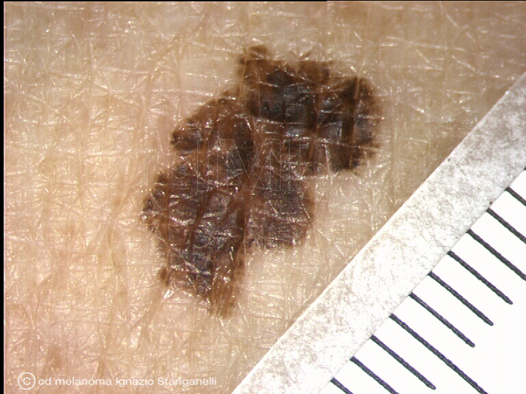 Melanoma piano superficiale