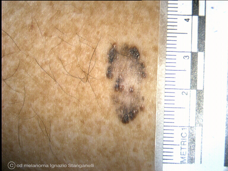 Melanoma piano superficiale 2