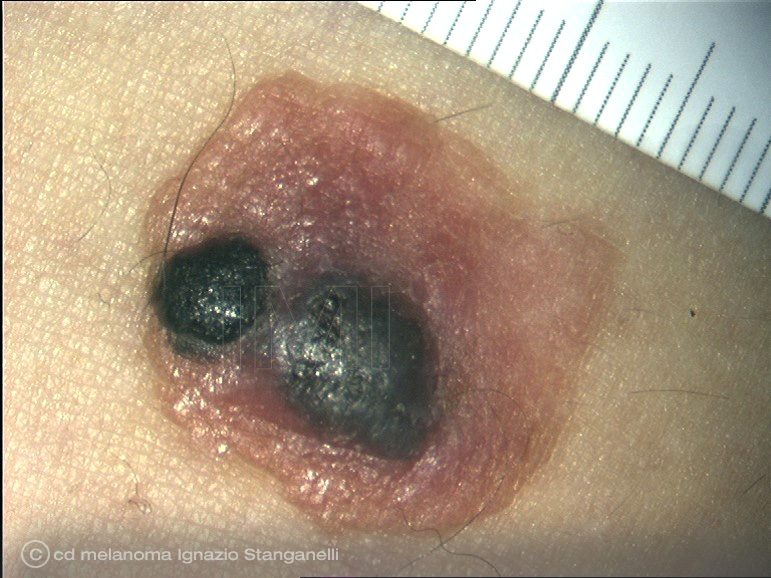 Melanoma piano-cupoliforme misto
